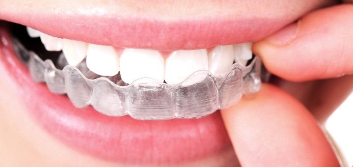 Виправлення прикусу у стоматології «SmileDesign» у Дніпрі. Записуйтесь до стоматолога з акції.