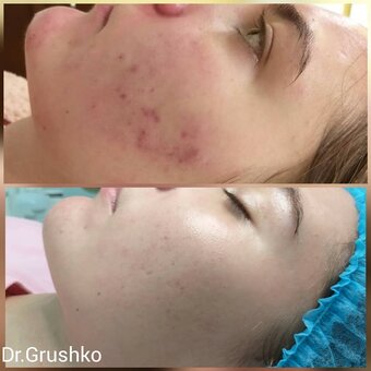 Acne treatment in the cosmetology studio of Lyudmila Grushko. Sign up for a discount