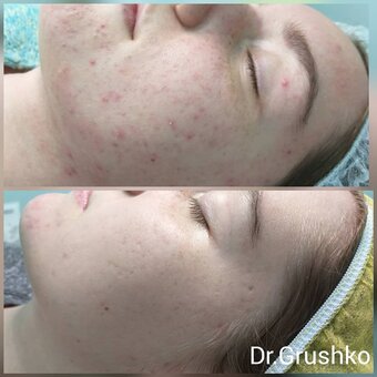 Treatment of rashes on the face in the cosmetology studio of Lyudmila Grushko. Sign up for a discount