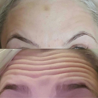 Косметологічний кабінет Олени кузьменко в Києві. усунення зморшок, акції.