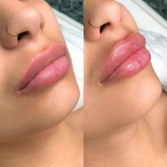 Косметолог Олена Кузьменко в києві. пластика губ знижка.