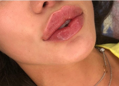 Косметологічний кабінет Олени Кузьменко в Києві. знижки на поліпшення форми губ.