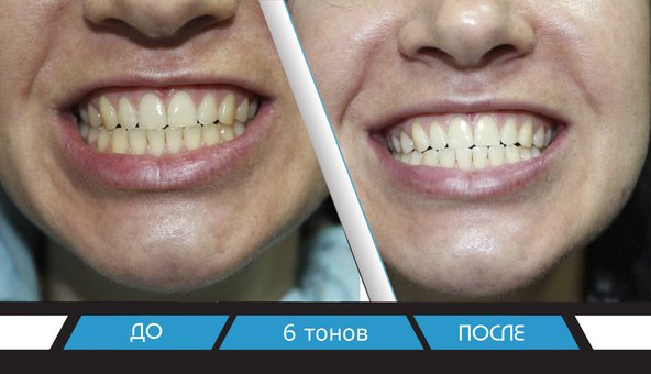Экспресс-отбеливание зубов в стоматологической клинике «Smile to you» в Днепре. Записаться со скидкой